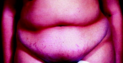 Fig 14 Central obesity with striae in Cushing syndrome Fig 15 - photo 4