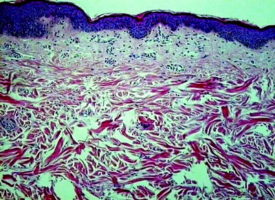 Fig 17 Histopathology of atrophic skin in Cushings syndrome HE stain - photo 7