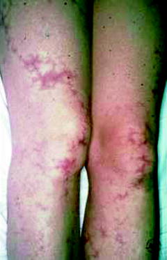 Fig 18 Purplish mottling of the limbs Hyperpigmentation is not a feature - photo 8