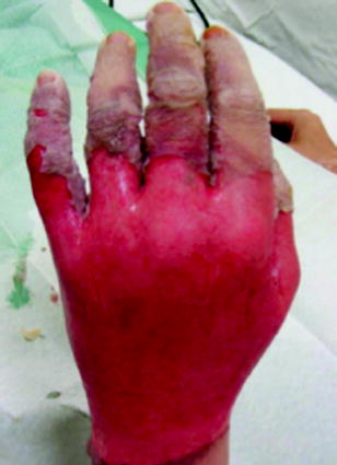 Fig 11 Early assessment of second degree burns over the dorsum of the hand - photo 1