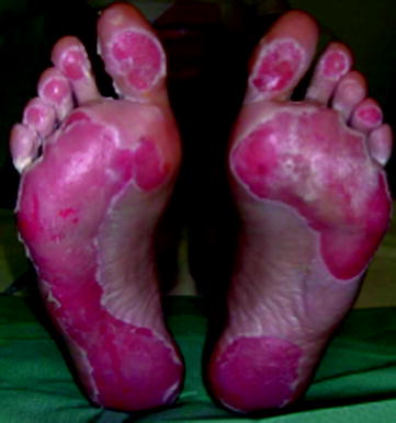 Fig 13 Sand burns of the palmar aspect of the feet after walking over a long - photo 3