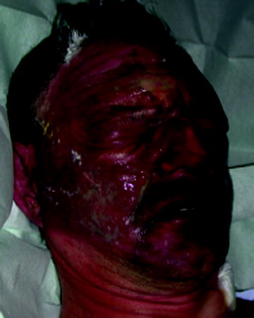 Fig 15 Fresh burns of the face Ophtalmologic assessment Removal of blisters - photo 5