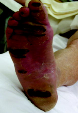 Fig 16 Deep grill burns of the plantar aspect of the foot on a diabetic - photo 6