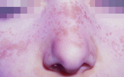 Fig 110 Vitiligo Fig 111 Radiodermatitis Postinflammatory - photo 10