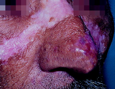 Fig 112 Discoid lupus erythematosus Hypopigmentation Erythema purpura - photo 12