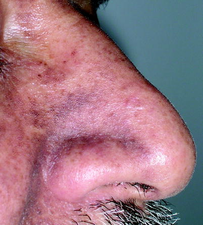 Fig 11 Drug-induced hyperpigmentation Fig 12 PUVA therapy-induced - photo 1