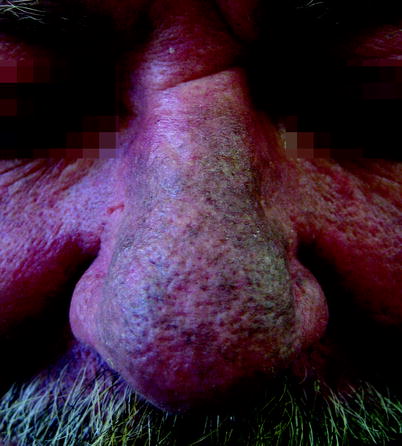 Fig 12 PUVA therapy-induced hyperpigmentation Skin lesions of ochronosis - photo 2