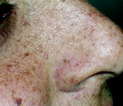 Fig 16 Xeroderma pigmentosum Fig 17 Lentigo malignant melanoma In - photo 6