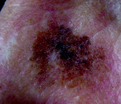 Fig 18 Lentigo malignant melanoma In situ stage Fig 19 Nevus of - photo 8