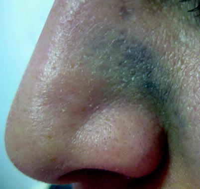 Fig 19 Nevus of Ota The hypopigmented macules on the nose are usually - photo 9