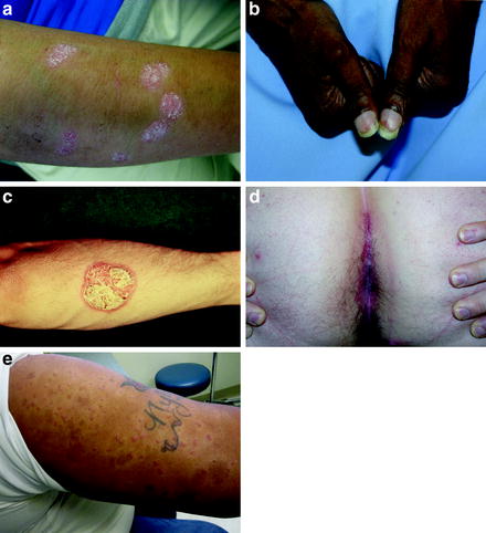 Figure 11 a Silvery scaling is present on the plaques in psoriasis b - photo 1