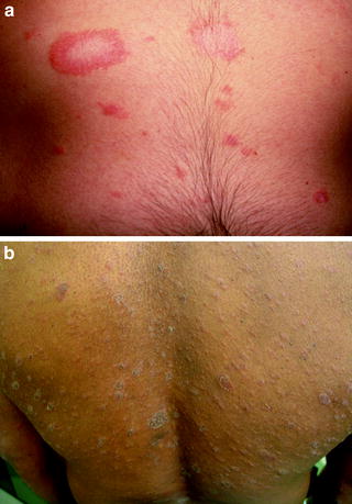 Figure 12 a The herald patch is the largest lesion seen in pityriasis - photo 2