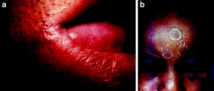 Figure 13 a A split papule is a fissured papule at the angle of the mouth - photo 3