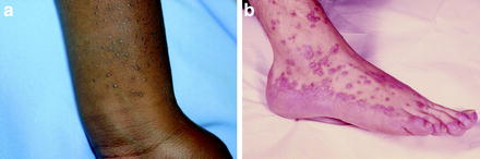 Figure 14 a Lesions of lichen planus are purple pruritic polygonal - photo 4