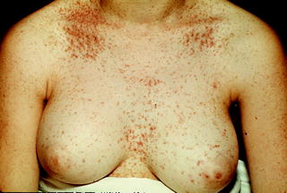Figure 15 Papules with a greasy feel are noted in Darier disease - photo 5