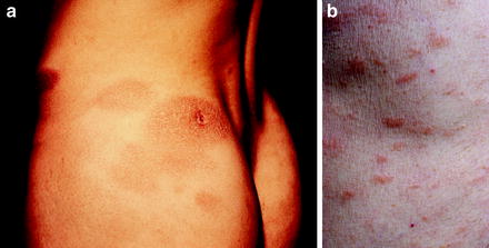 Figure 16 a Fawn-colored patches are noted in parapsoriasis b Oval - photo 6