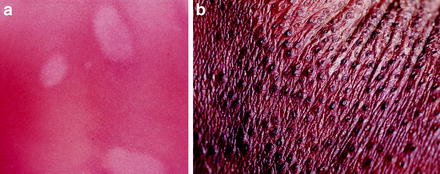 Figure 17 a Islands of sparing in a confluent red scaling eruption are - photo 7