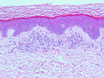 Fig 11 Pigmented purpuric eruption Schamberg variant shows a mild - photo 1