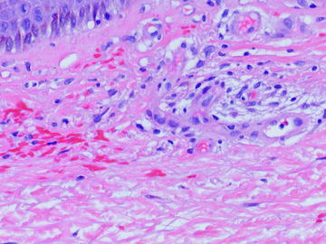 Fig 12 Pigmented purpuric eruption Schamberg variant This high-power image - photo 2