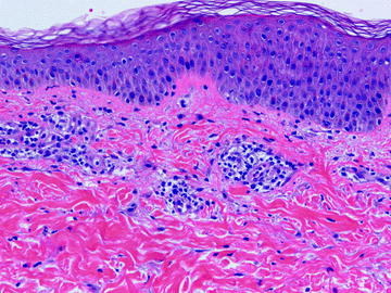 Fig 13 This viral exanthem shows a superficial perivascular lymphohistiocytic - photo 3