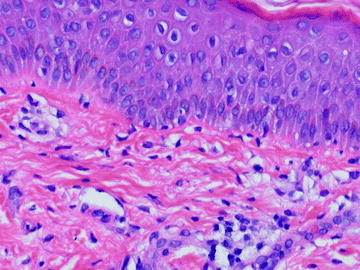 Fig 14 Mild spongiosis and interface degeneration are seen in this viral - photo 4