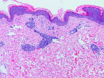 Fig 15 Erythema annulare centrifugum is characterized by a lymphohistiocytic - photo 5