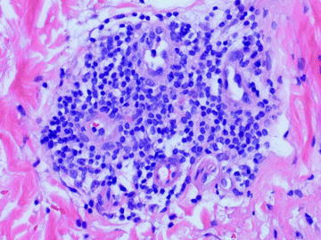 Fig 16 Erythema annulare centrifugum characteristically has a - photo 6