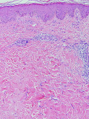 Fig 17 Erythema chronicum migrans shows a superficial perivascular - photo 7