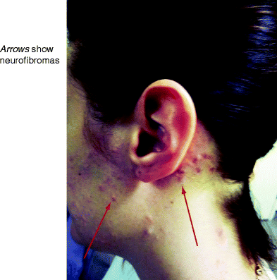 Figure 11 Segmental NF1 Cutaneous neurofibromas around the left side of the - photo 1