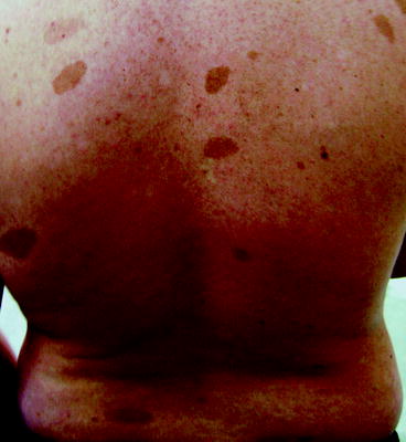 Figure 12 Multiple caf au lait patches Freckling Freckling is observed - photo 2