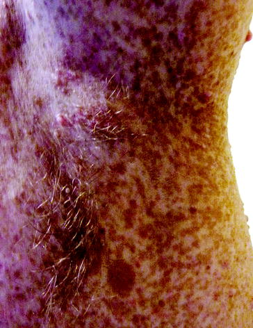 Figure 13 Axillary freckling Campbell de Morgan Spots Campbell de - photo 3