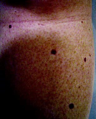 Figure 14 Campbell de Morgan spots cutaneous angiomas are associated with - photo 4