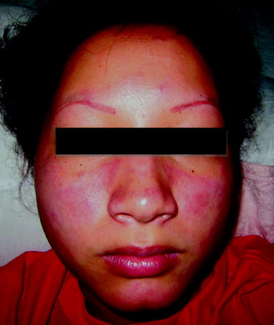 Fig 1 Acute cutaneous lupus erythematosus associated with systemic lupus - photo 1