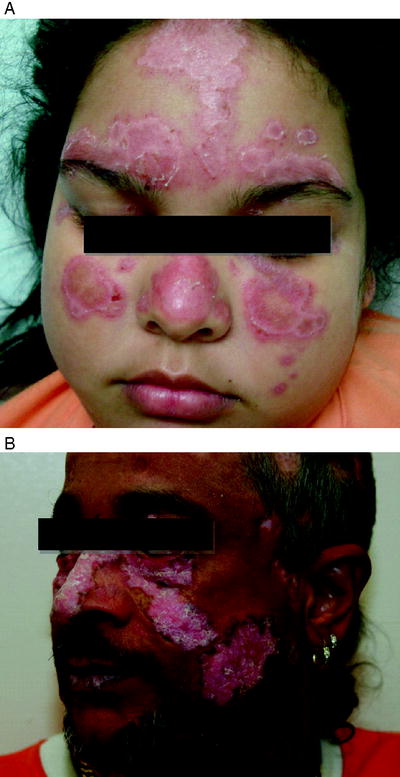 Fig 2 a b Discoid lesions of lupus erythematosus chronic cutaneous - photo 2