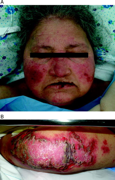 Fig 5 a b Exacerbation of systemic lupus erythematosus presenting - photo 5