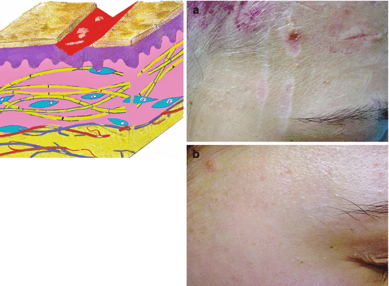 Fig 11 Temple scratches a Before b After Atrophic scar An - photo 2