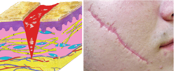 Fig 12 Atrophic scar of the cheek Hypertrophic scar and keloid If an - photo 3