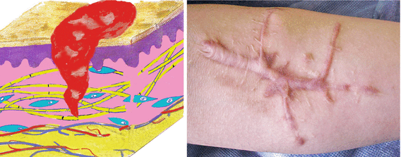 Fig 13 Forearm keloid Normotrophic scar Swelling and inflammation - photo 4