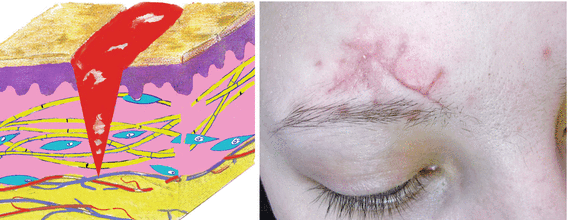 Fig 14 Normotrophic scar of the forehead Sluggish Inflammation of Phase - photo 5