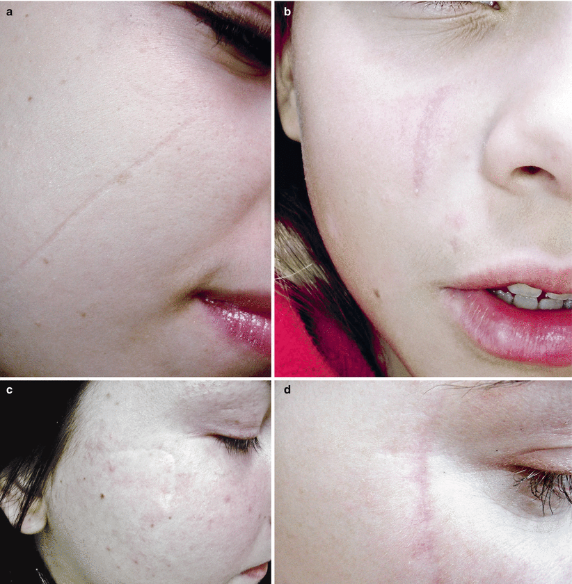 Fig 18 Cat-scratch scars a b Right cheek c d Right zygomatic area - photo 9