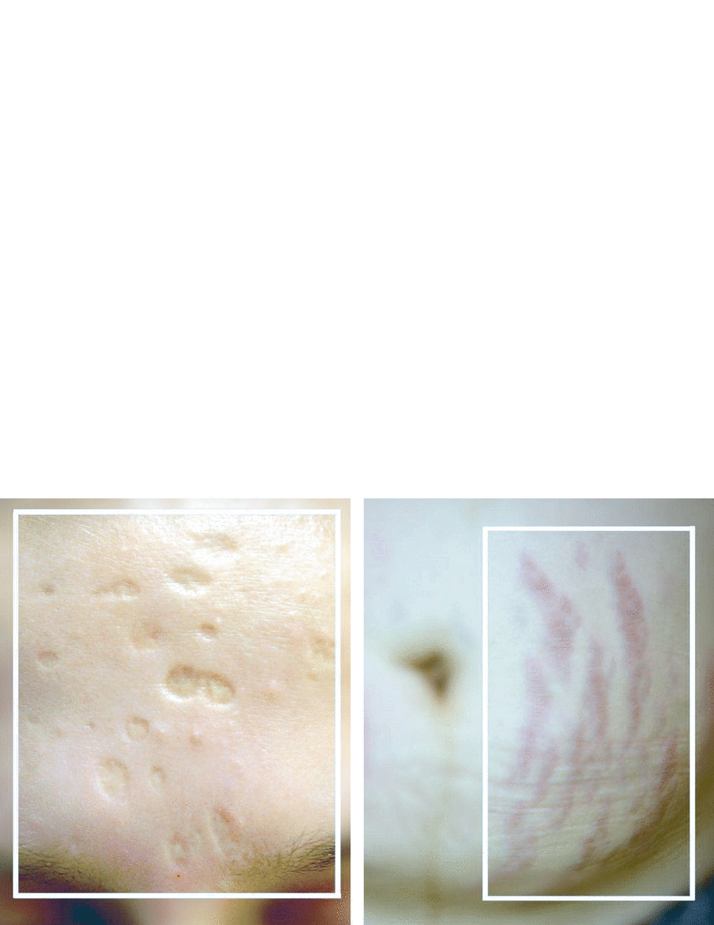 Atrophic scars are the most numerous compared to others The common feature of - photo 1