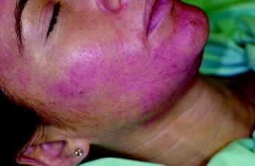 Fig 11 Homogeneous erythema following peeling with pyruvic acid 50 Mild - photo 1