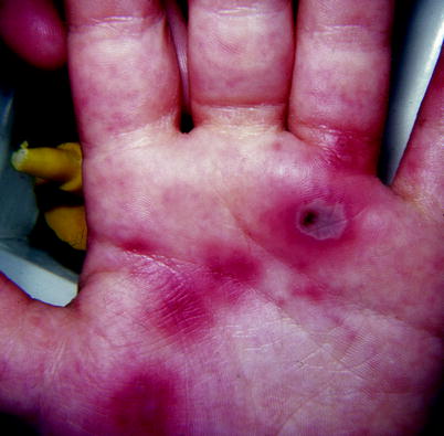 Figure 11 Purpuric papules and a gray flat bullae due to Aspergillus flavus - photo 1