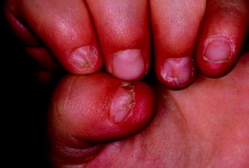 Fig 23 Nail patella syndrome nail hypoplasia and triangular lunula - photo 3