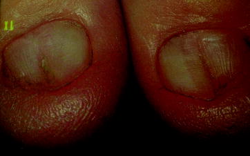 Fig 25 Nail patella syndrome the condition is bilateral and symmetric - photo 5