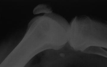 Fig 26 Nail patella syndrome X-ray showing hypoplasia of the patella - photo 6