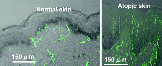 Fig 11 Elongation of free nerve endings into the epidermis in atopic - photo 1