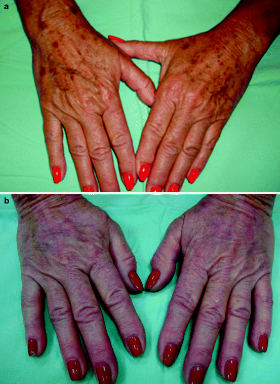 Fig 11 a Significant photoaging and numerous lentigines prior to - photo 1