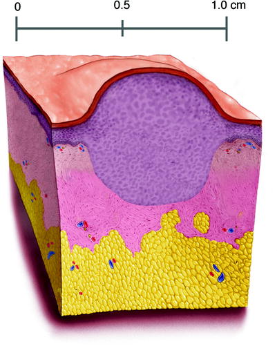 Fig 15 Plaque-Elevated flat-topped solid lesion gt05 cm in diameter - photo 5