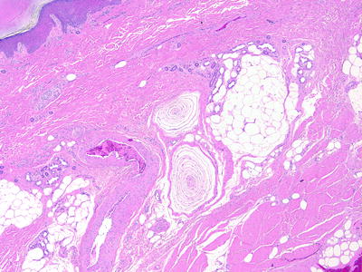 Fig 15 Pacinian corpuscles are located in the reticular dermis of subcutis in - photo 5